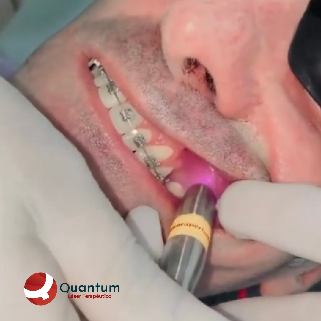 Láser Quantum Mini Dental